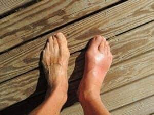 symptoms of sore ankles after running