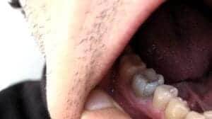 Cracked tooth syndrome 1