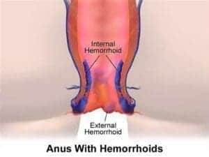 Hemorrhoids high fiber diets 