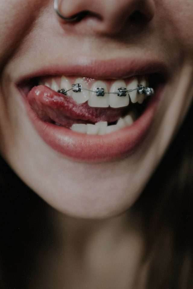 Braces and Age