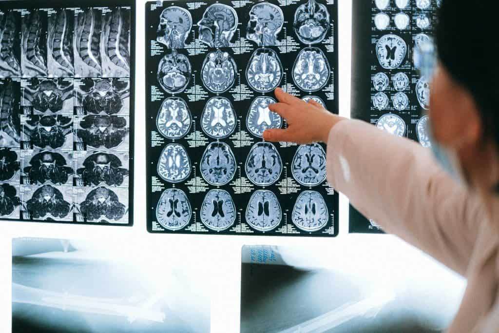 what are the five stages of parkinson disease