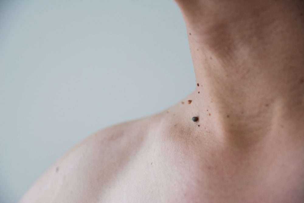 Wart Vs Mole: 4 Most Astonishing Differences 2 shutterstock 1025109607