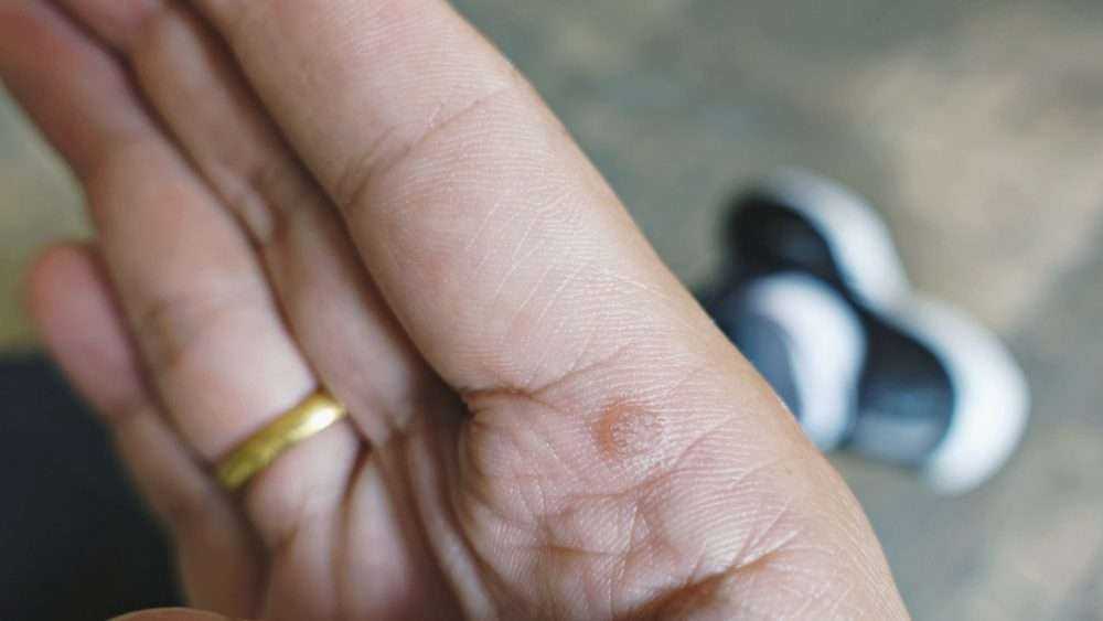 Wart Vs Mole: 4 Most Astonishing Differences 3 shutterstock 1315746140