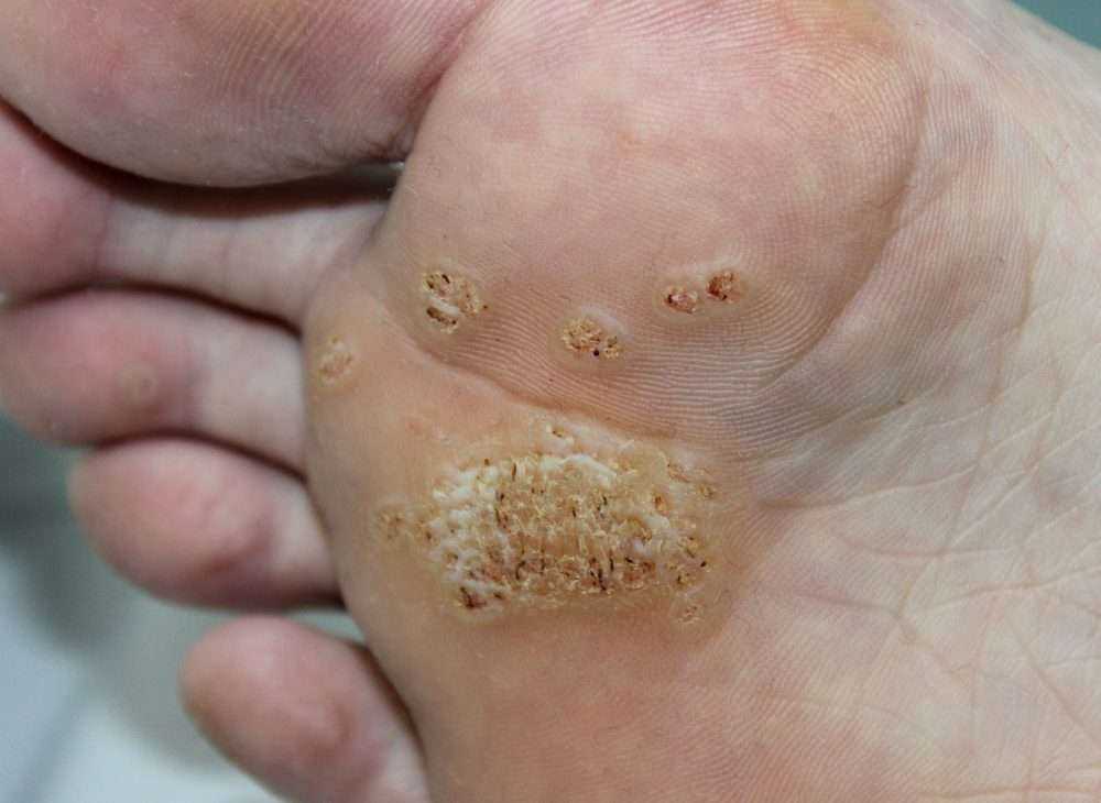 Wart Vs Mole: 4 Most Astonishing Differences 4 shutterstock 1338361754