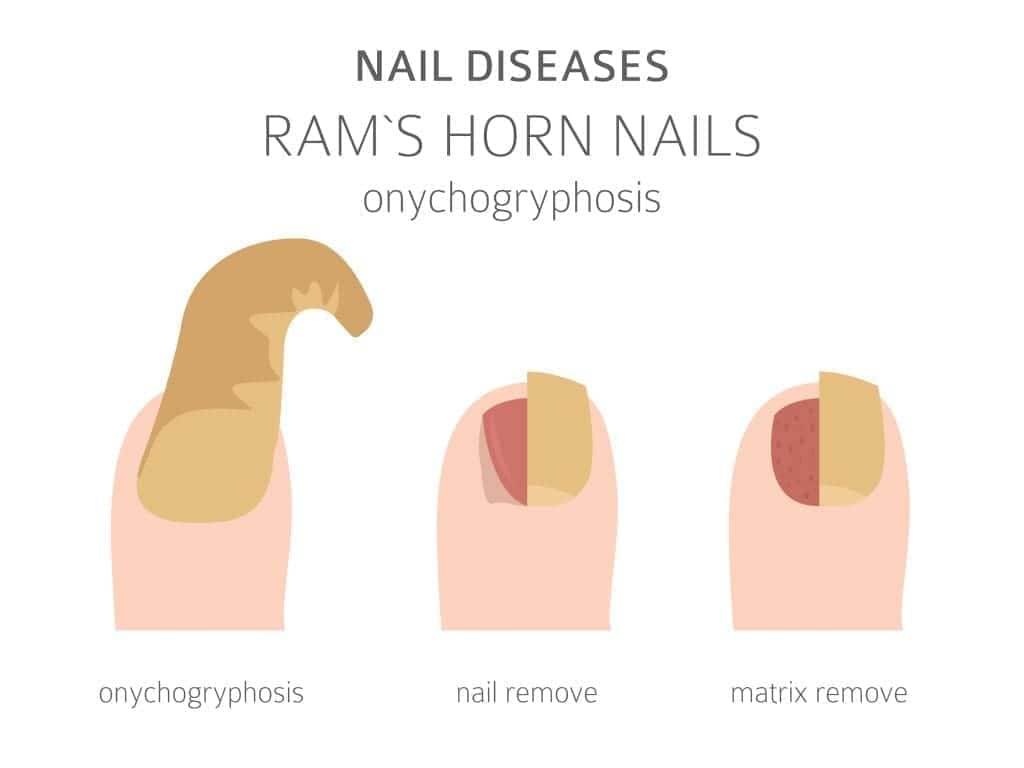 Ram's Horn Nails