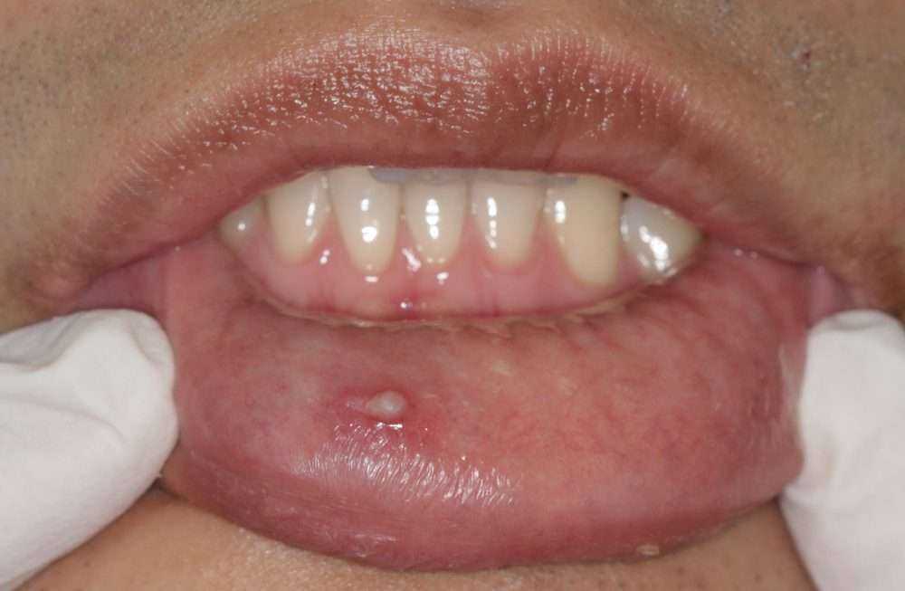 Wart Vs Mole: 4 Most Astonishing Differences 5 shutterstock 1941739102