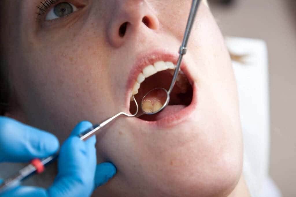 795098 checking for dental cavities