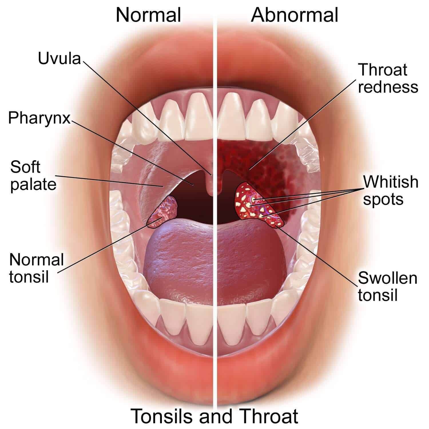 tonsillitis 