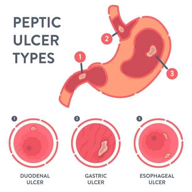 Stomach Ulcers
