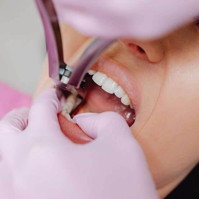 how long do wisdom teeth take to heal - extraction