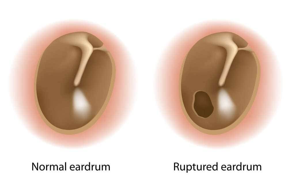 signs that tinnitus is going away-perforated eardrum