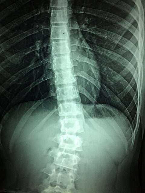 A Detailed Guide On Lower Back Pain Causes And Remedies 9 Lower back pain causes and remedies