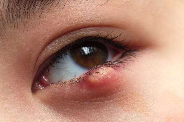 Styes In The Eye: Major Causes And 6 Effective Remedies 2 istockphoto 1318506671 612x612 1