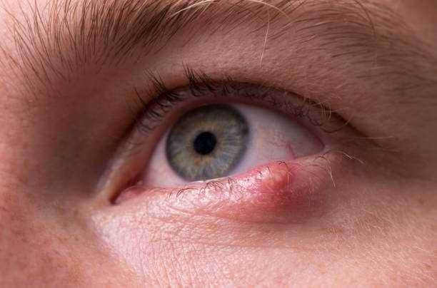 Styes In The Eye: Major Causes And 6 Effective Remedies 1 Styes in the eye