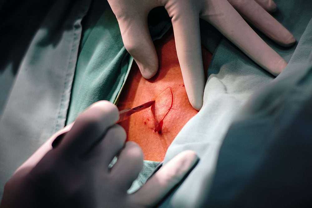 Sebaceous Cyst: Definition and 3 Commonly Used Surgical Excision Techniques 5 shutterstock 1517926112