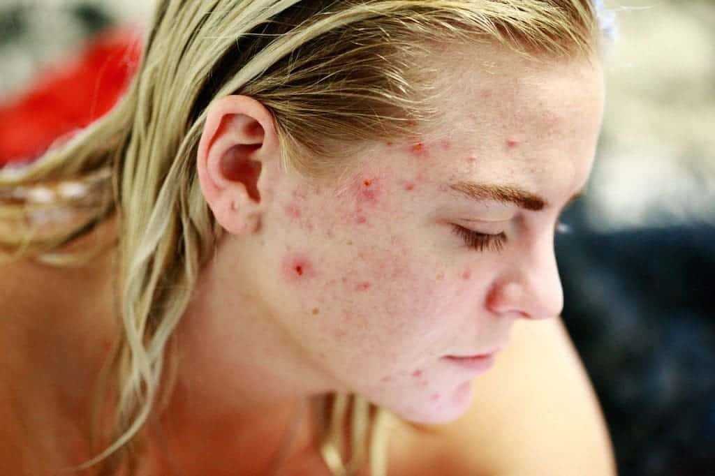 Tea Tree Oil for Acne: 3 Tips No One Told You About 1 Tea tree oil for acne