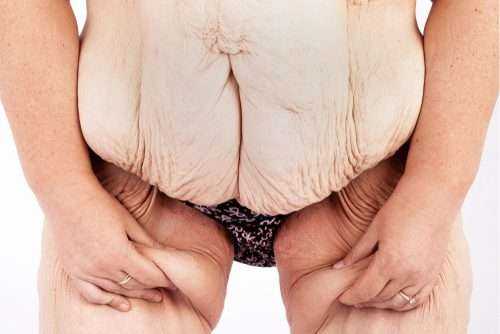 4 Excellent Ways To Address Loose Skin After Weight Loss 3 shutterstock 1212150277