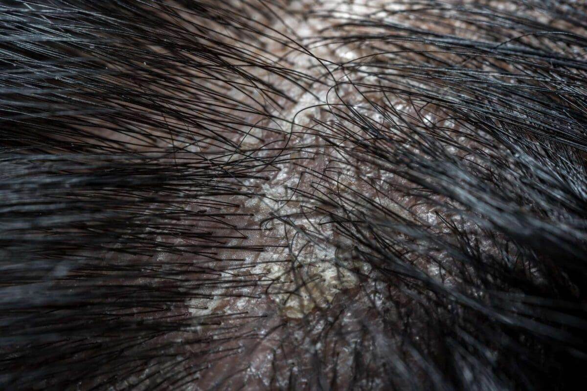 dry scalp