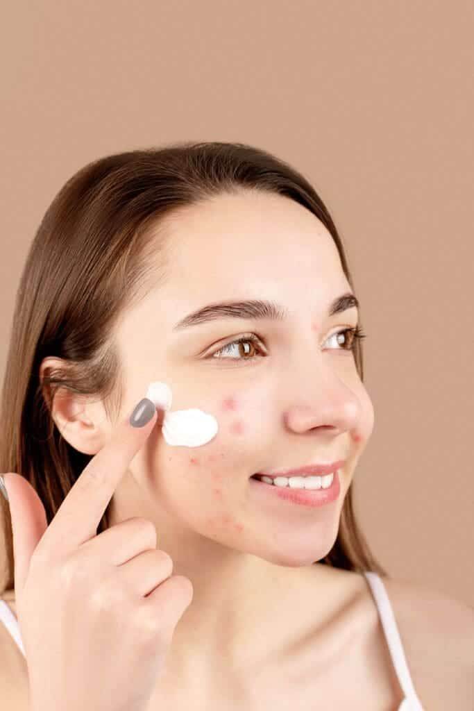 cream on acne prone skin