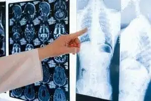 Discover 8 Significant Long Term Effects Of Bulimia 3 long term effects of bulimia