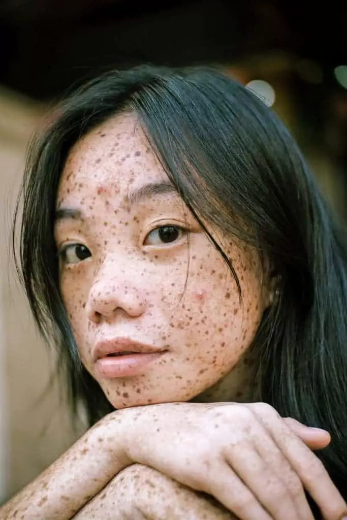 white spots on skin