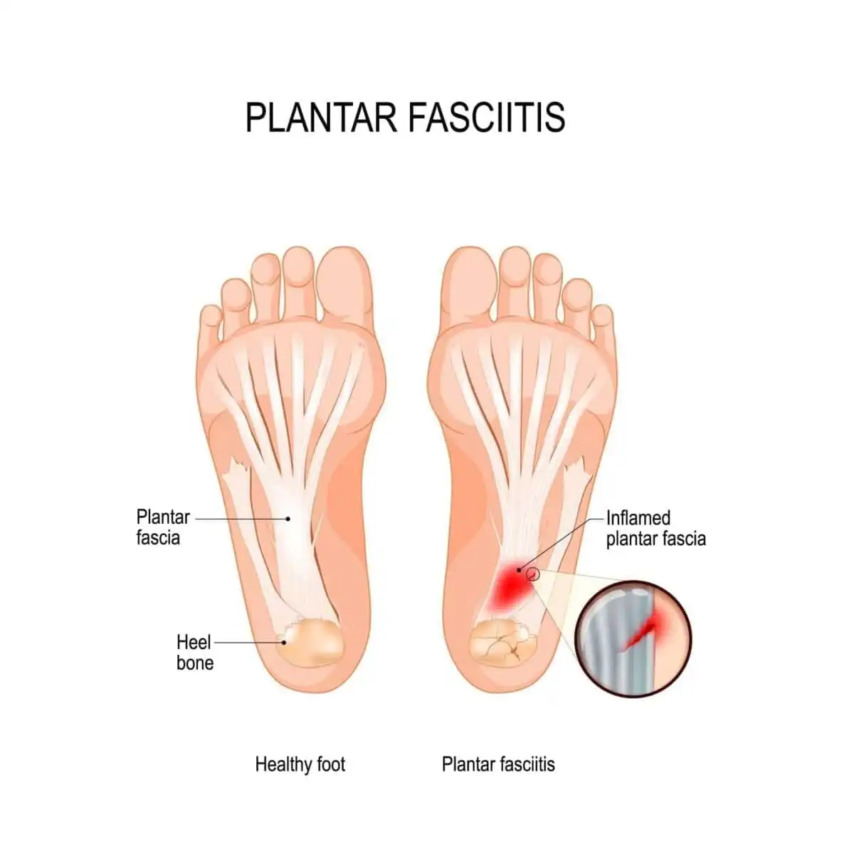 How to Cure Plantar Fasciitis in 1 Week: 10 Best Options 2 shutterstock 1442092880