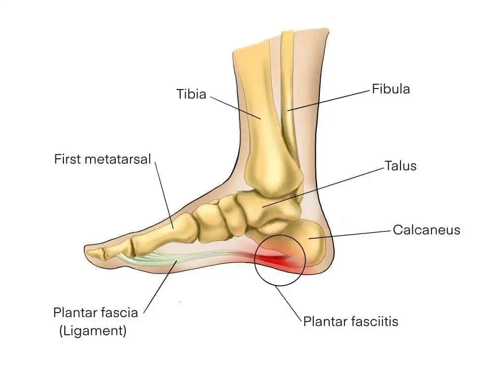 How to Cure Plantar Fasciitis in 1 Week: 10 Best Options 1 shutterstock 1561980778