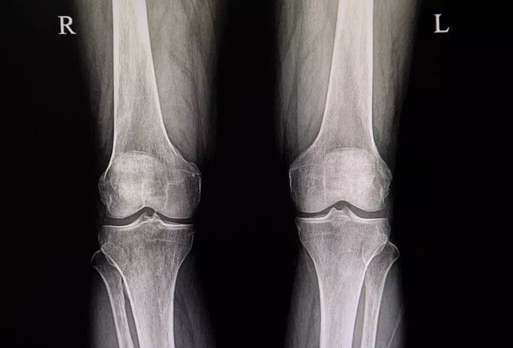 32089852 osteoarthitis of both knees