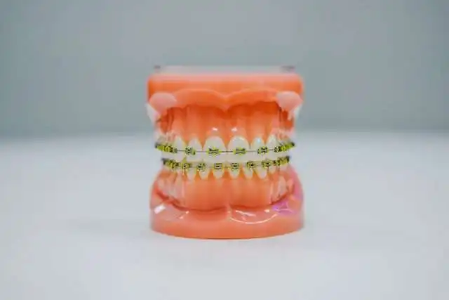 Malocclusion Of Teeth: 8 Causes And Effective Treatments 3 neonbrand 6gKvN8qFGxA unsplash