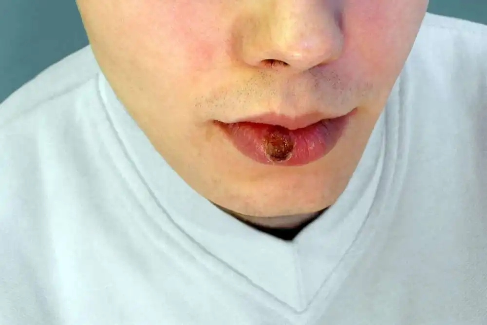 What do Bumps on Back of Tongue Mean: 10 Likely Reasons 5 shutterstock 1138695668 1