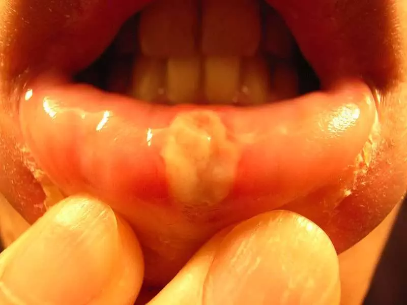 causes of Roof of mouth sore