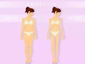 29889190 before and after anorexia 1