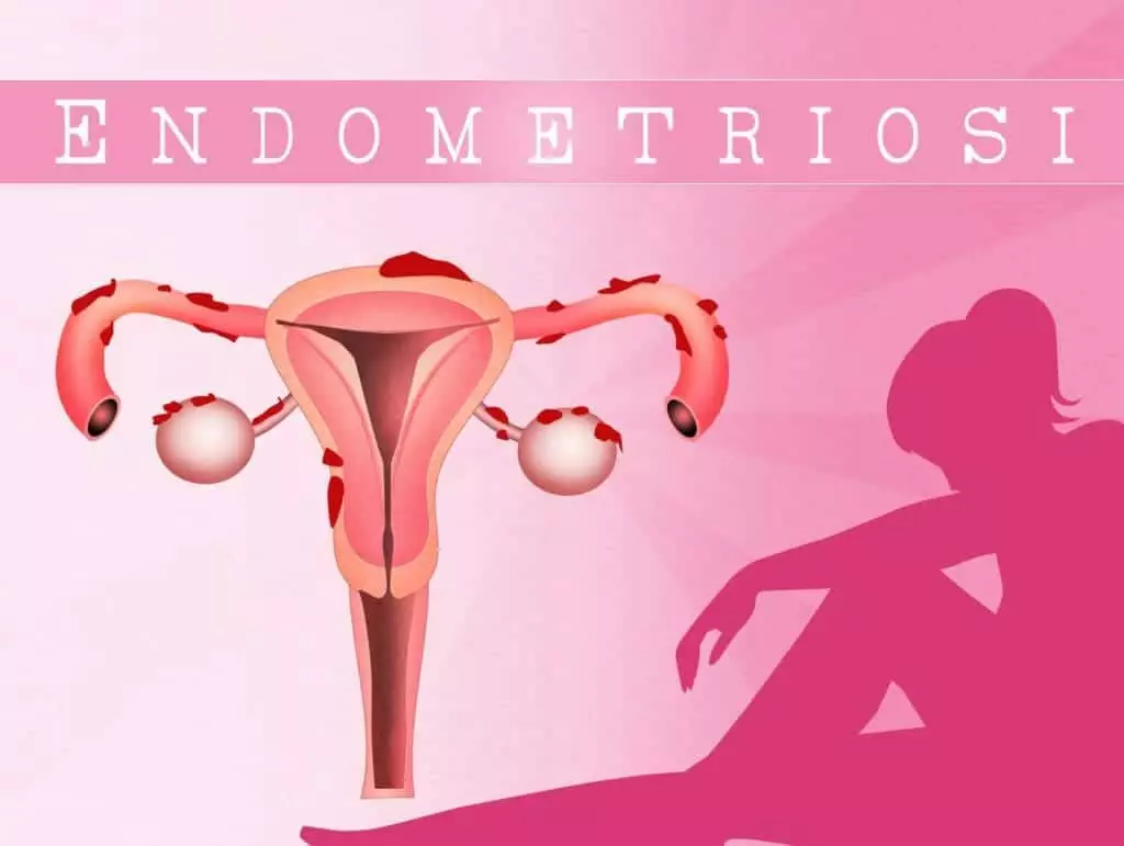 21354976 endometriosis disease