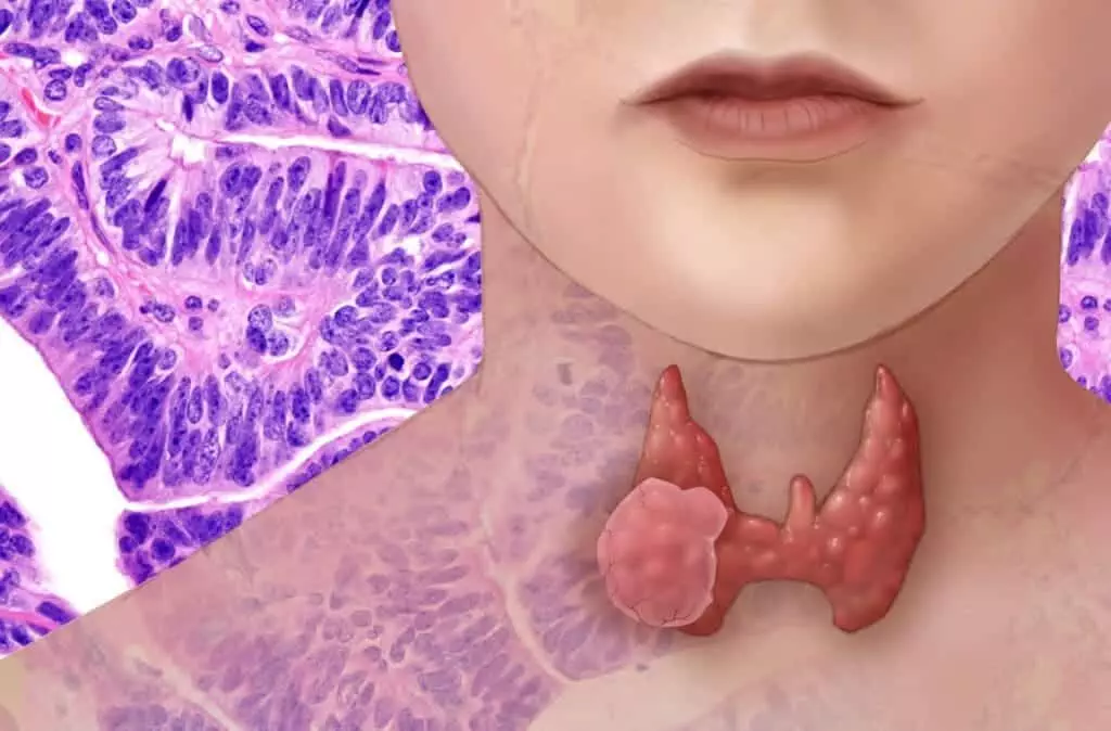 Anaplastic thyroid cancer