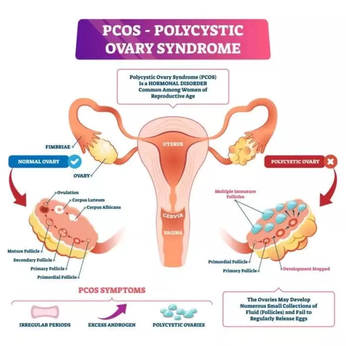PCOS Awareness Quotes