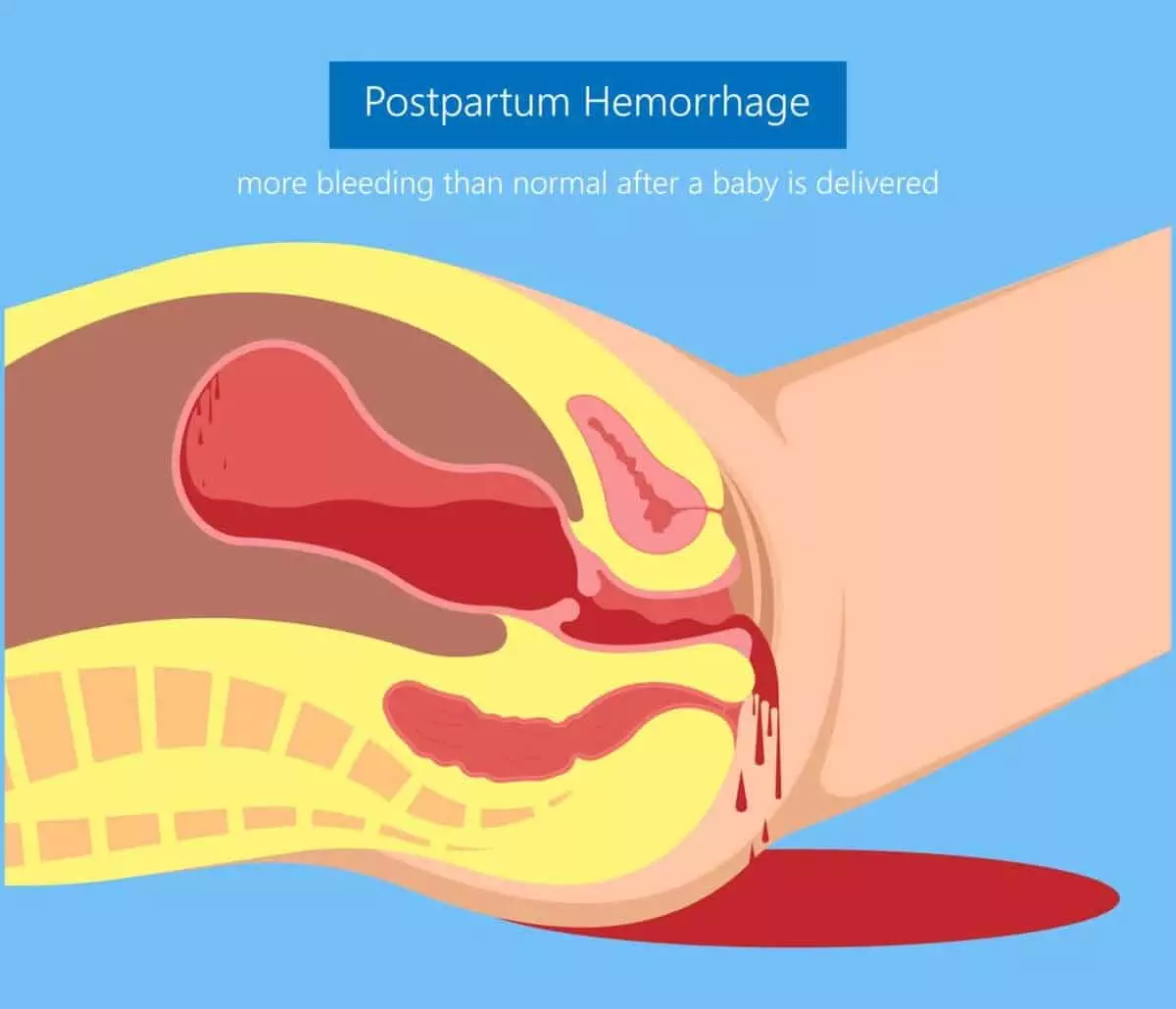 what is postpartum hemorrhage